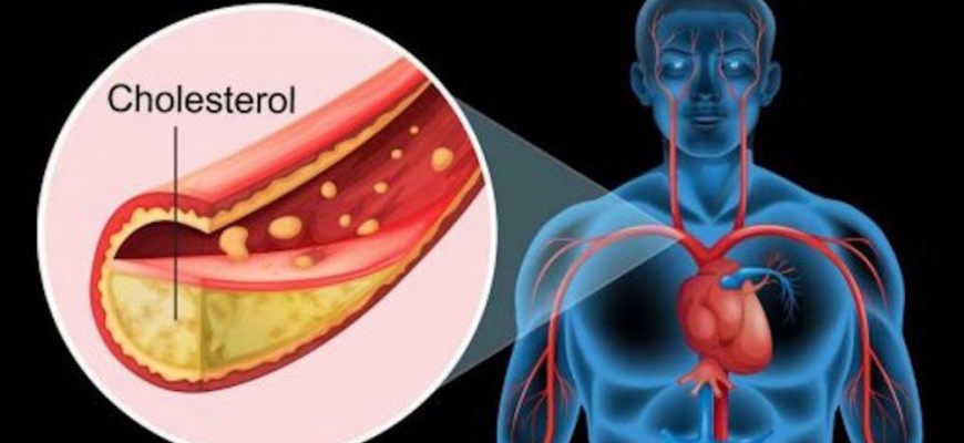 Вот как вычистить сосуды от холестерина за 40 дней без единого лекарства