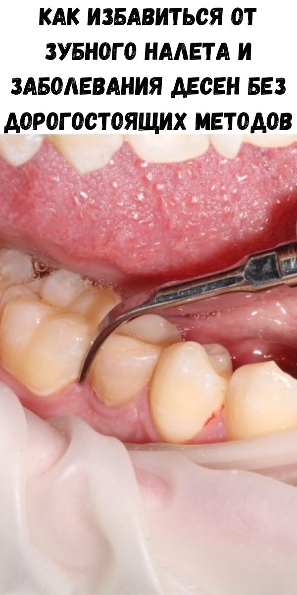 Как избавиться от зубного налета и заболевания десен без дорогостоящих методов