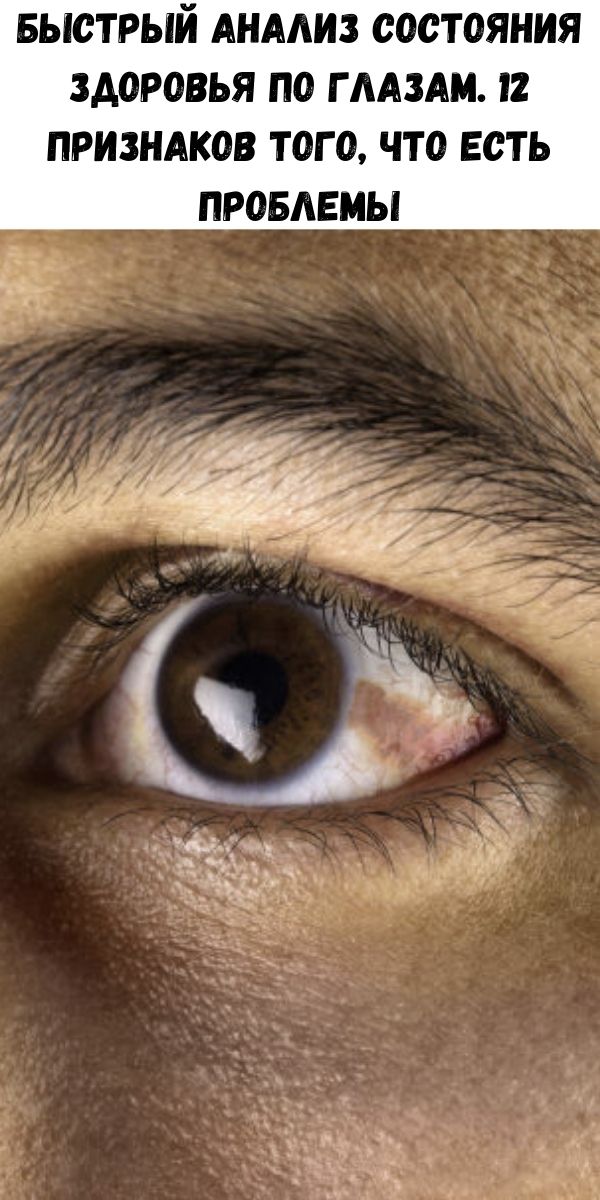 Быстрый анализ состояния здоровья по глазам. 12 признаков того, что есть проблемы