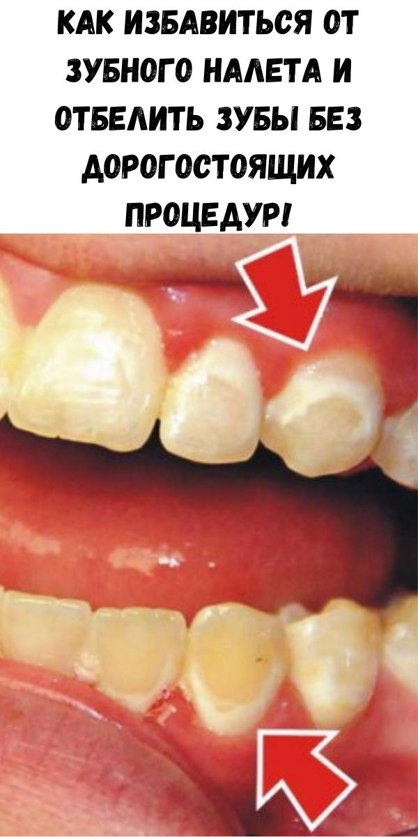 Как избавиться от зубного налета и отбелить зубы без дорогостоящих процедур!