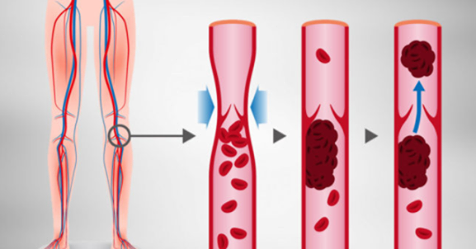7 признаков того, что ваши артерии заблокированы и как их лечить