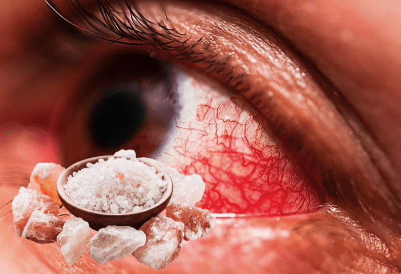 Как солевой раствор поможет при глазной инфекции