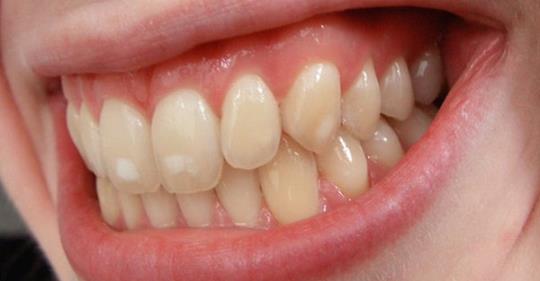 Одиннадцать советов по лечению белых пятен на зубах