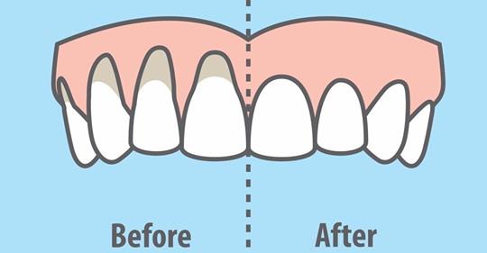 10 легких способов исцеления оголенных десен естественным способом