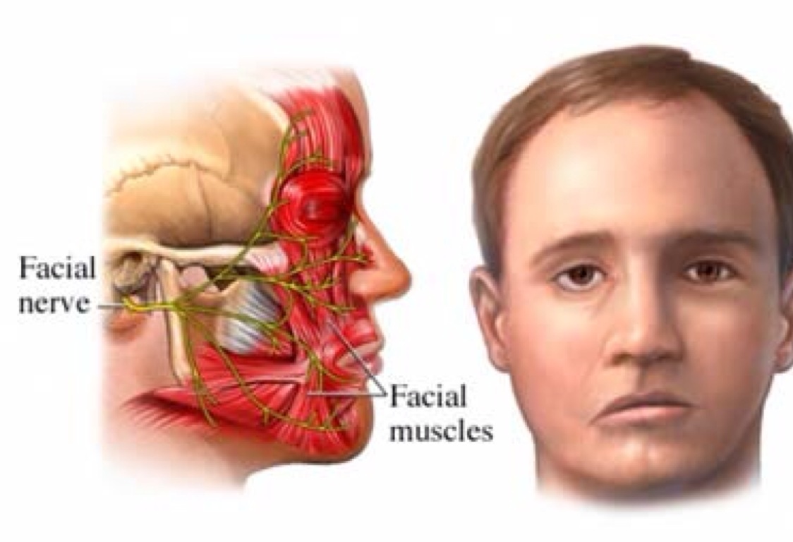 Воспаление тройничного нерва на лице симптомы фото