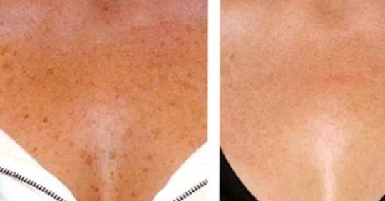 3 природных способа устранения коричневых пятен на вашей коже