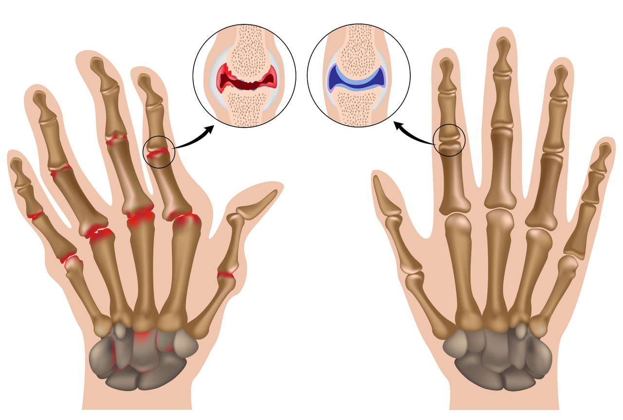 При артрите пальцев рук поможет специальная гимнастика