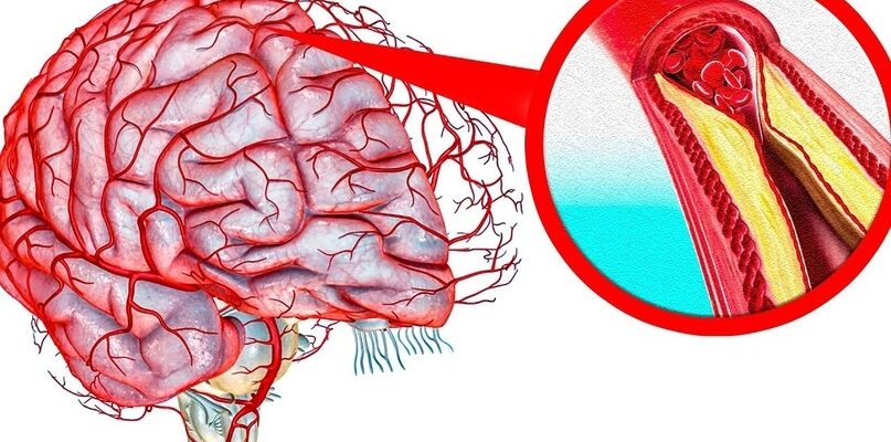 3 простых рецепта для очищения сосудов головного мозга
