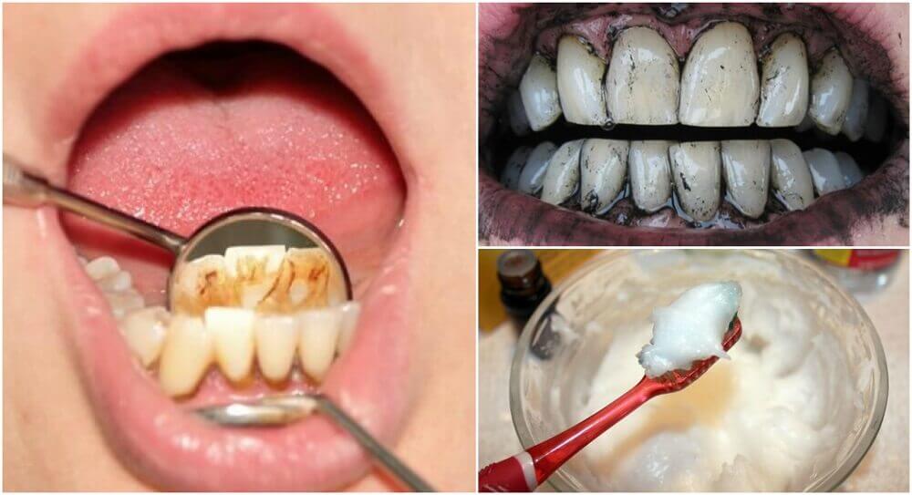3 эффективных домашних средства для удаления зубного камня