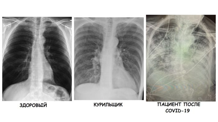 Врач сравнила рентген-снимки здорового, курильщика и больного коронавирусной инфекцией