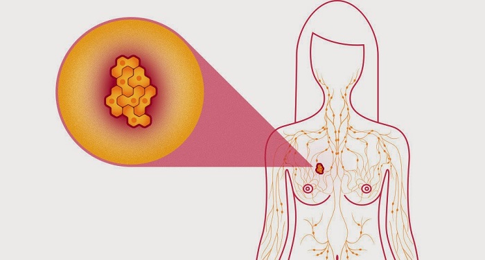 Ученые обнаружили: эти 2 ингредиента излечат даже рак молочной железы!
